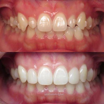 Invisalign and Bioclear composite veneers