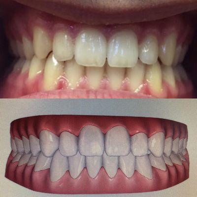 Digital simulation of patient's teeth after Invisalign treatment.