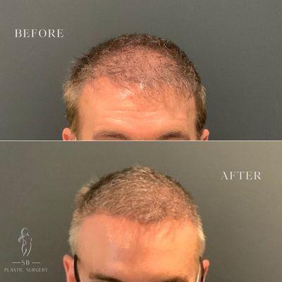 FUE Hair Transplant