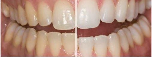 In-office Whitening