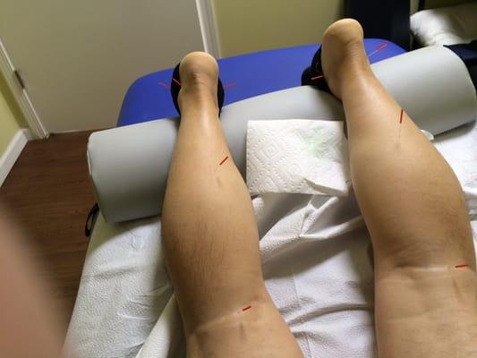 Photos of my sessions of acupuncture