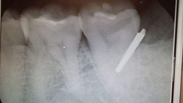 The mental piece found during xray. Looks bad,  but I since it's under the bones I don't feel a thing.