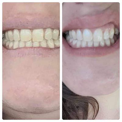 She never expected her teeth to become this white before trying my teeth whitening treatment! She was in tears