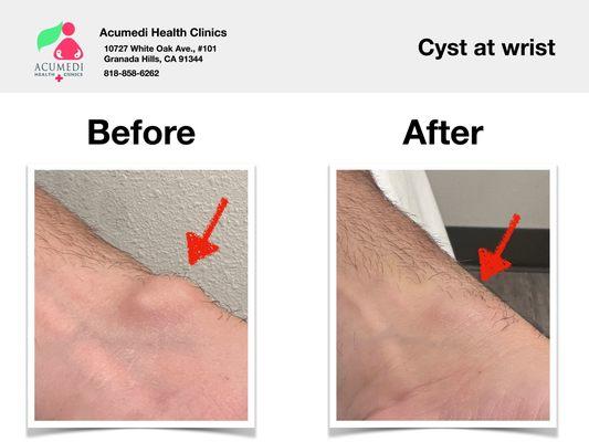 Cyst in wrist with 3 treatments