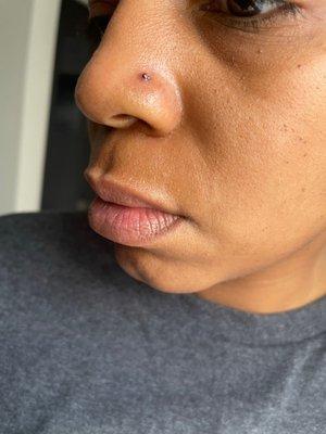 2 days after piercing (sinking has begun and more bleeding/irritation)