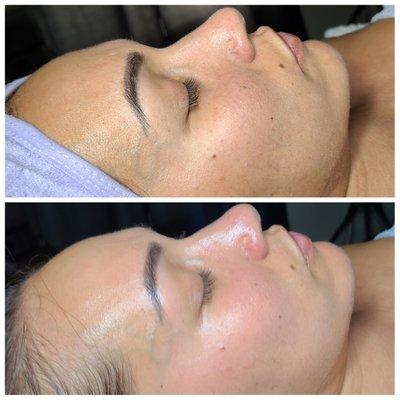 Custome facial results