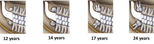 Wisdom teeth growth