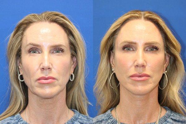 6 Months Post Op. Vertical Restore, Custom Fat Transfer, Upper Blepharoplasty.