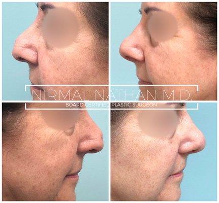 6 months after revision rhinoplasty