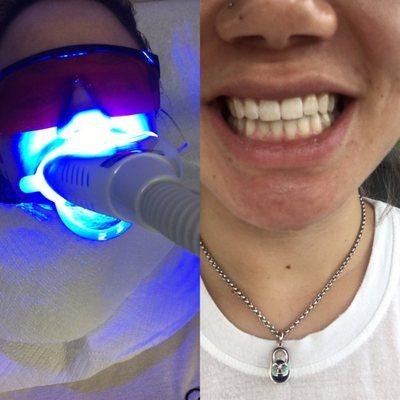 In the process of whitening & after my two 20 minute sessions.