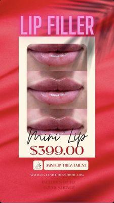 Mini Lip - only $399 with Ultra XC or Restylane-L