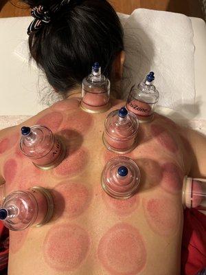 Cupping detoxing by pulling the muscle fibers up and allowing oxygenated blood to flow more easily.