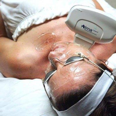 IPL/Photo Facial