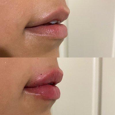 Lip Filler treatment.