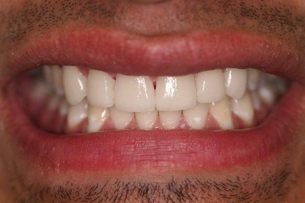 Porcelain Veneers on front upper 6 teeth