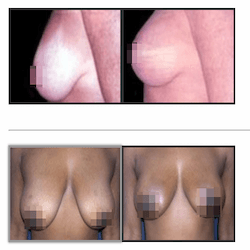 Breast Lift