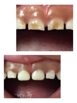 Before and After photos of pediactric white crowns