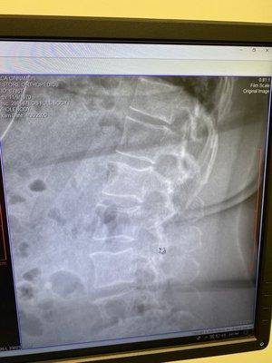 X-Ray of my back.