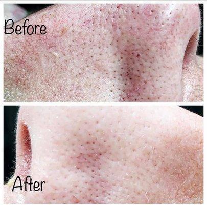 This client came in this last weekend -her skin literally changed during her treatment!