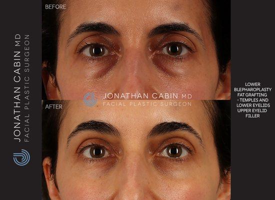 1 year after lower blepharoplasty with fat grafting to the lower eyelids and temples, and filler to the upper eyelids.