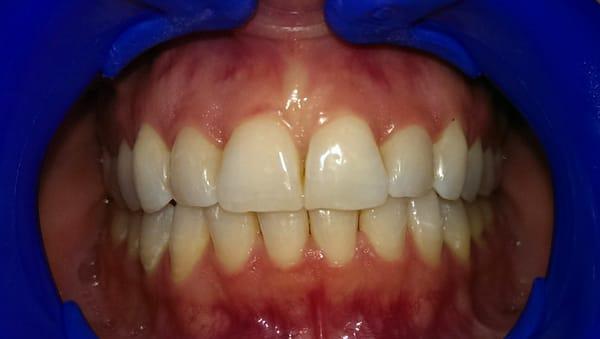 Orthodontic correction with Clear Braces (ClearCorrect) after 8 months of treatment. This is 'after' photo
 Presidio Dental San Francisco