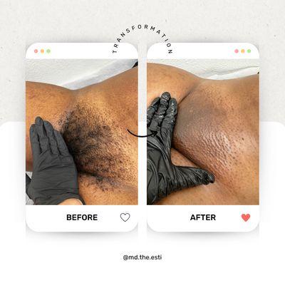 Before & After of Brazilian Wax