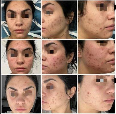 One treatment of our PicoSure Pro for her acne scarring and pigmentation.