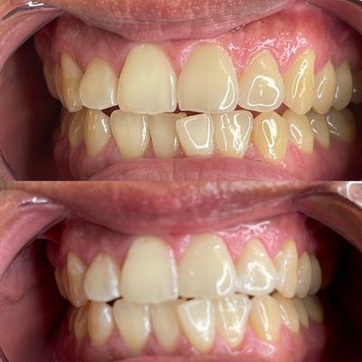 Teeth whitening service. Before and after