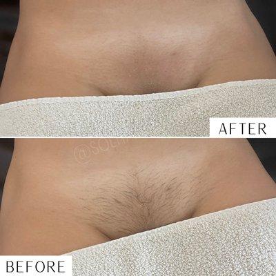 Full Sugar Brazilian wax