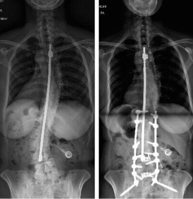 Revision surgeries for adjacent segment surgeries