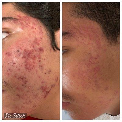 Acne Bacteria Removed. Beginning of Scar Removal