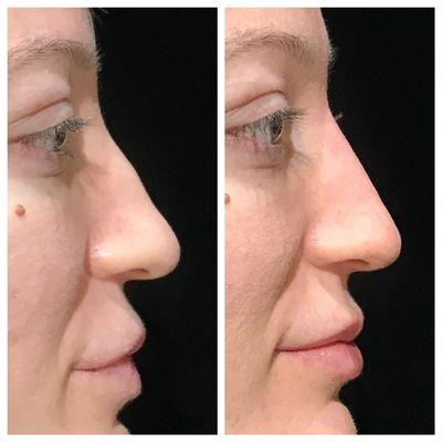 Liquid rhinoplasty with dermal fillers to straighten the nose