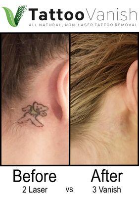 Tatoo Laser removal two treatments. No Laser