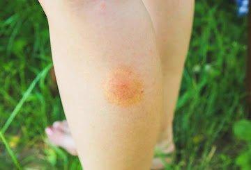 https://healthicall.blogspot.com/2022/07/difference-between-mosquito-bites-and.html