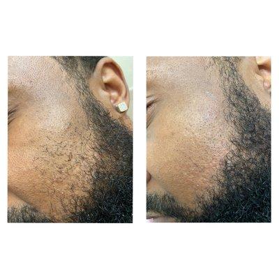 Men's Facial Wax