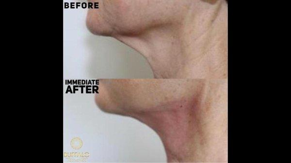 PDO Thread Neck Lift