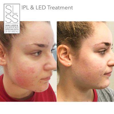 IPL & LED Treatment