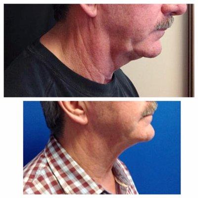 We offer Kybella in our office, This treatment Creates and Defines Jawline and Gets Rid of Doublechin fat Permanetly!