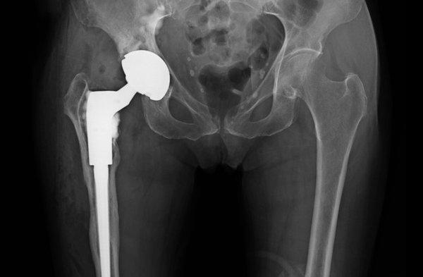 Revision Total Hip with Anterior Approach