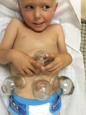 Cupping on Children