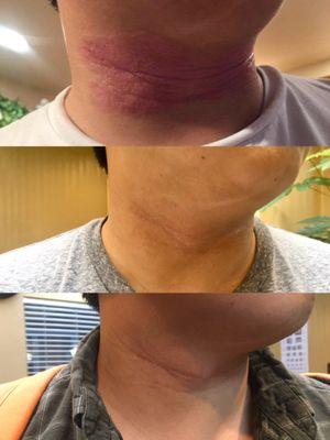 Patient's neck before treatment, during treatment, and after treatment.