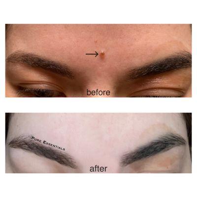 Mole Removal. Top photo: removed a raised mole on forehead Aug '21. Bottom photo: after photo taken by client Oct '21