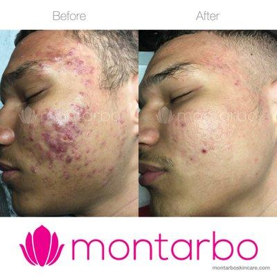 Acne and scar peel