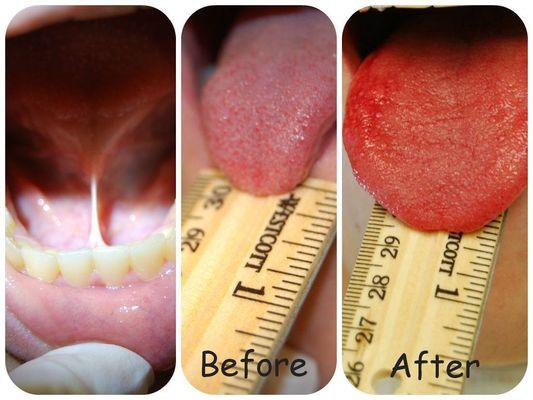 NJ Tongue Tie Procedure