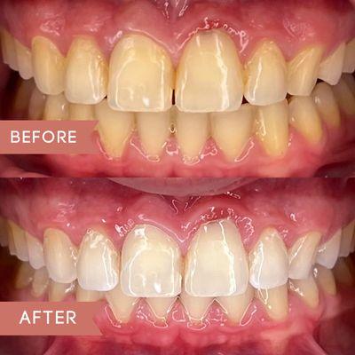 In just one hour we transformed this gorgeous smile 12 shades!!