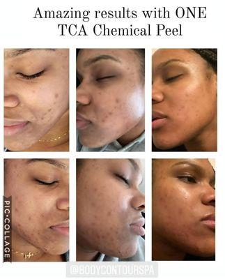 Chemical Peels https://bodycontourspa.square.site/