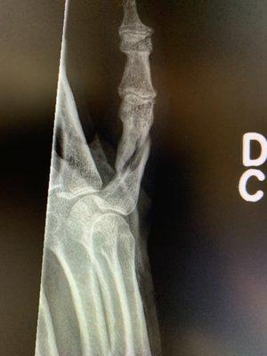 Spiral fracture right pinky