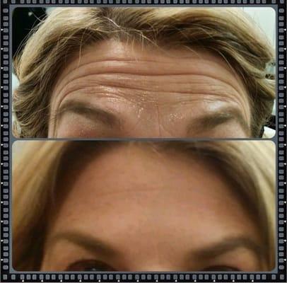 Frown lines injected with botox. A procedure that takes minutes but takes years off in the span of 4-7 days!