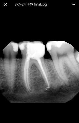 Root Canal Treatment