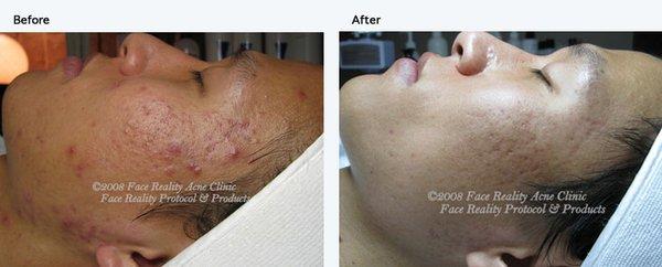 Before and After of Acne Client on Face Reality Acne Program